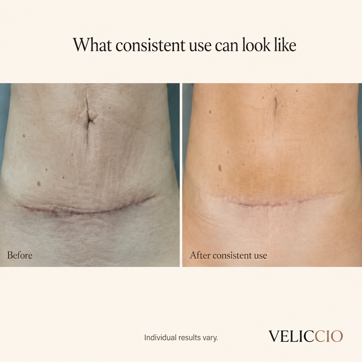 Veliccio C-Section Silicone Scar Sheets