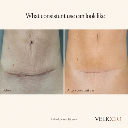 Veliccio C-Section Silicone Scar Sheets